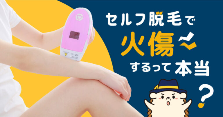 セルフ脱毛で火傷するって本当？原因や対処方法を解説