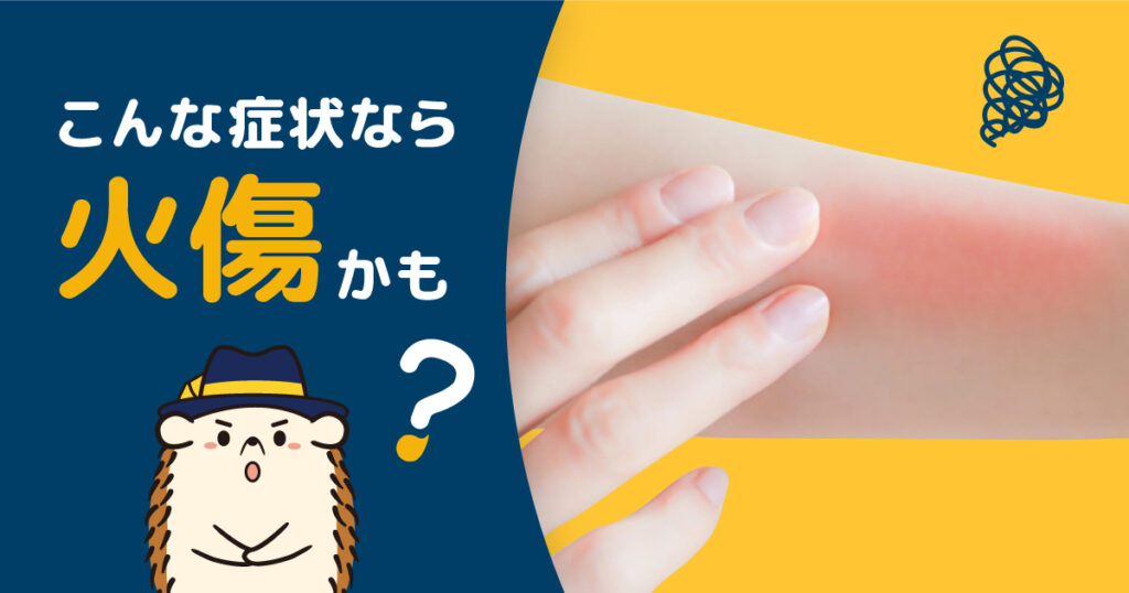 こんな症状があったら火傷かも？