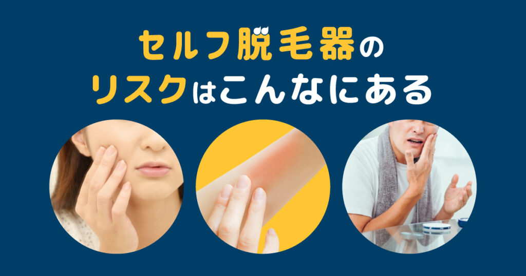 セルフ脱毛器のリスクはこんなにある！