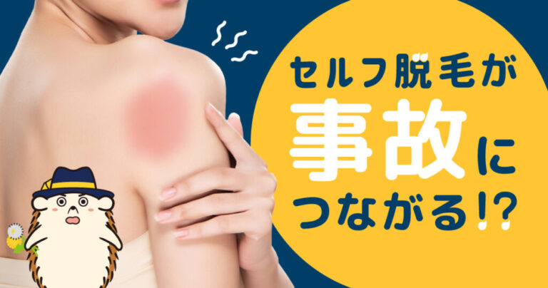 セルフ脱毛が事故につながる!？思わぬトラブルを避けるために知っておきたい3つのこと