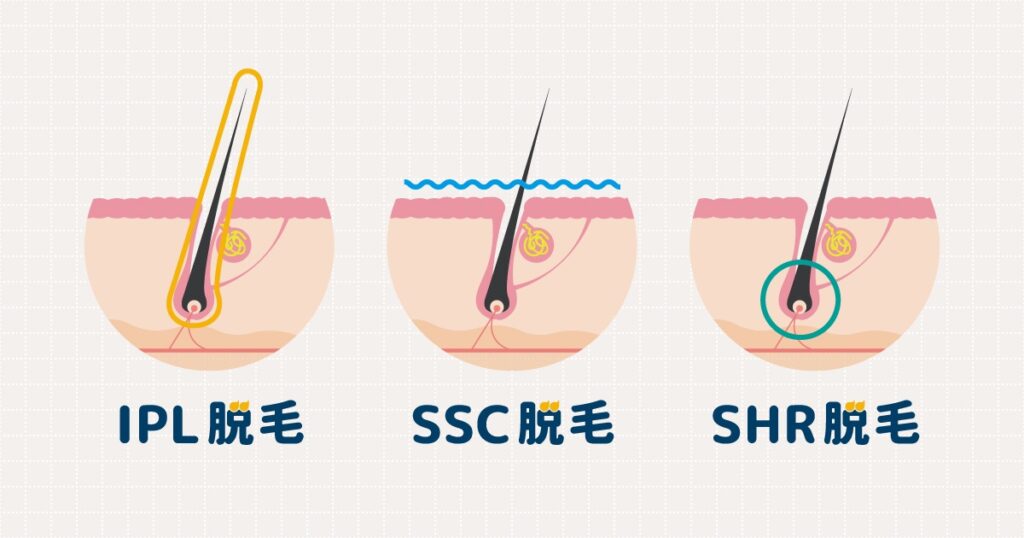 IPL脱毛とSSC脱毛、SHR脱毛の違いは