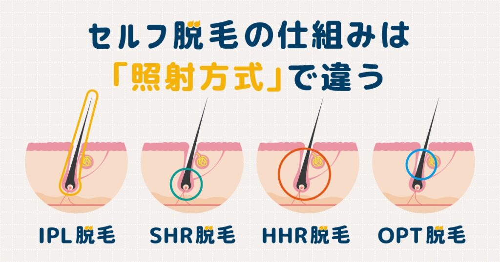 セルフ脱毛の仕組みは照射方式で違う